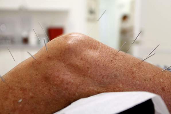 Acupuncture on leg.jpg